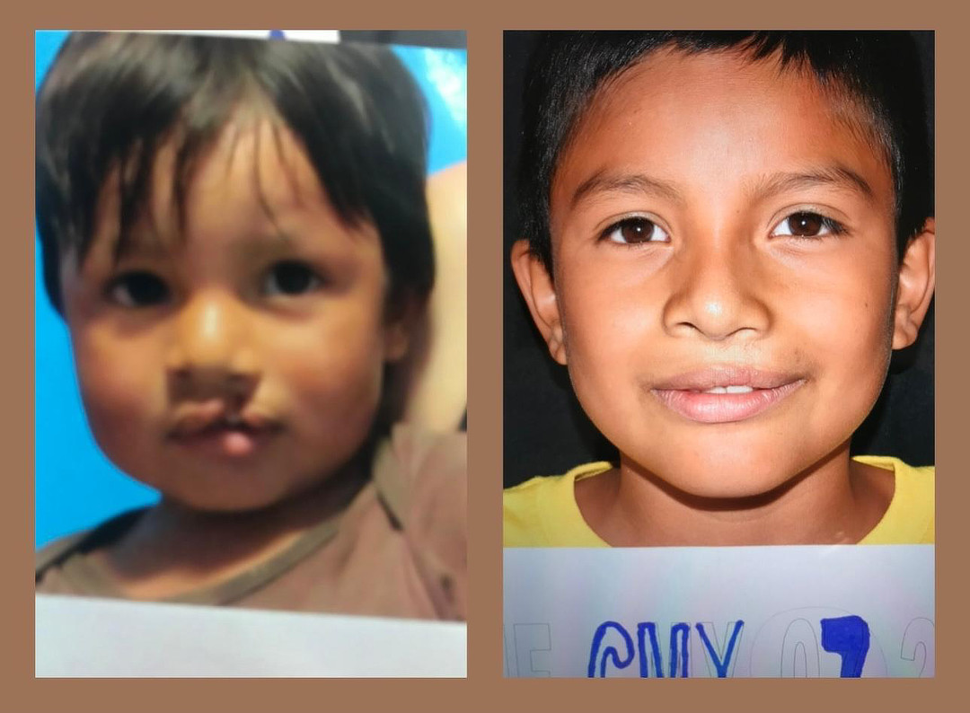 Mexico: CaboSmiles Mission – Correcting Cleft Lips and Palate Deformities February 2026