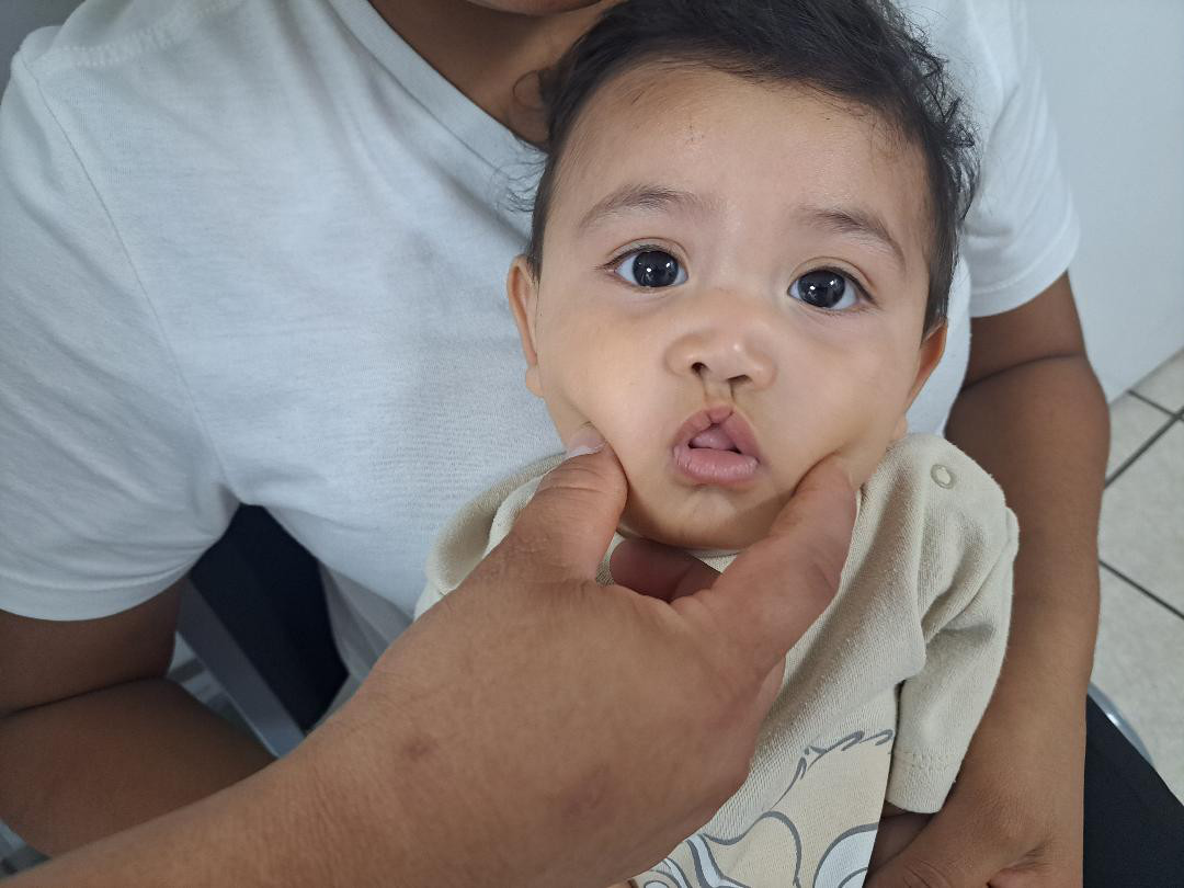 Mexico: TecateSmiles Mission – Mexico: CaboSmiles Mission – Correcting Cleft Lips and Palate Deformities